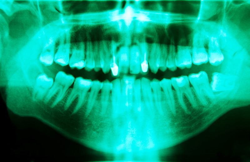Are dental X rays safe? Understanding radiation exposure